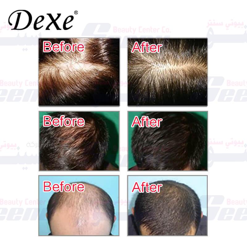 Dexe Hair Building Fibers before after dexe-hair-building-fibers-22g-3